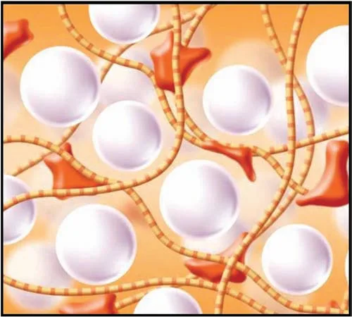 Fig 6. The CaHA microsphere in soft tissue with collagen infiltration